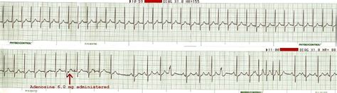 EKG 69 - SVT/Adenosine