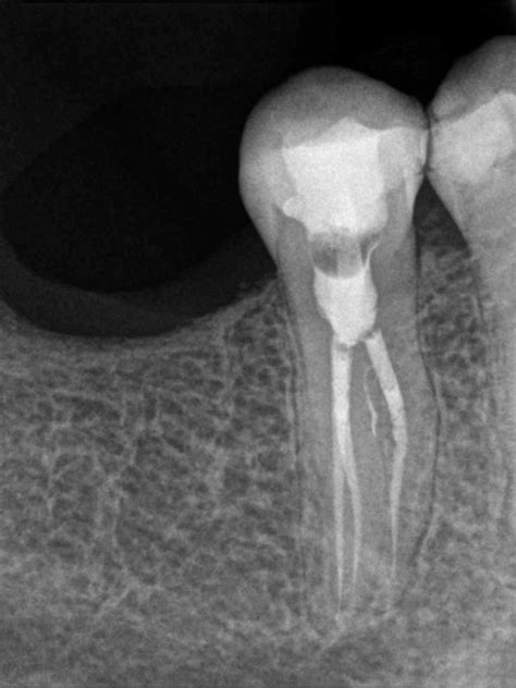 Mandibular bicuspid with aberrant anatomy. – Root Canal Specialty ...