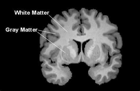 White matter alterations found in brains of college athletes after ...