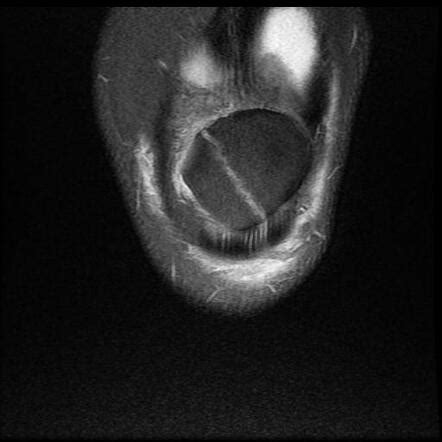 Patellar fracture (MRI) | Radiology Case | Radiopaedia.org