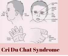 Cri du chat syndrome[54] Cri du chat syndrome is due to a partial ...