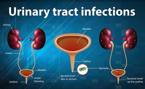 12 Most Frequent UTI Causes: You're Not Alone!