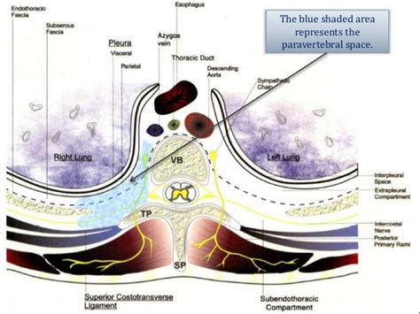 Ultrasound-Guided Thoracic Paravertebral Block