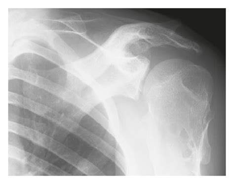 Anteroposterior radiographs of the left shoulder (a) 8 years before the ...