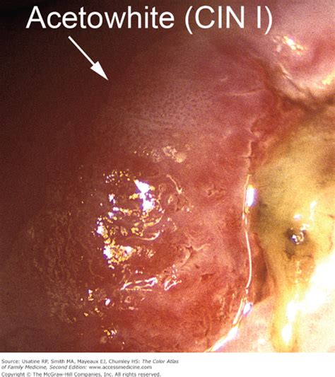 Colposcopy of Low-Grade Lesions | Basicmedical Key