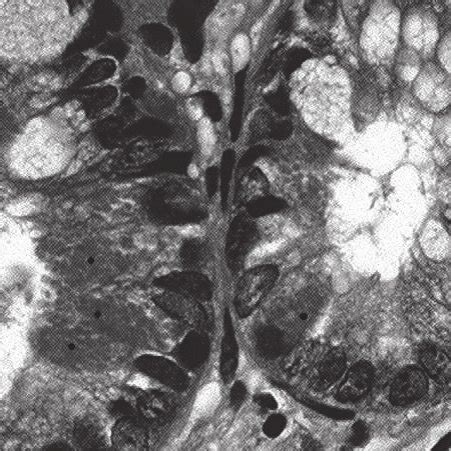 Paneth cell metaplasia: presence of Paneth cells (•) lined crypts in ...