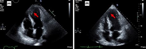 Use of direct oral anticoagulants in the treatment of left ventricular thrombi: A tertiary ...