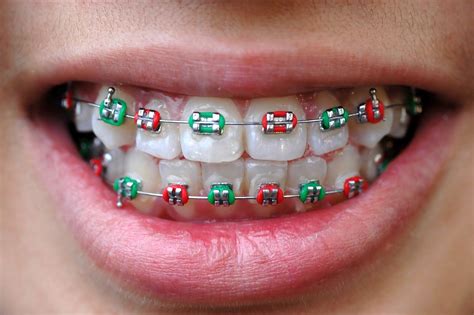 What Color Of Braces Should I Get Quiz