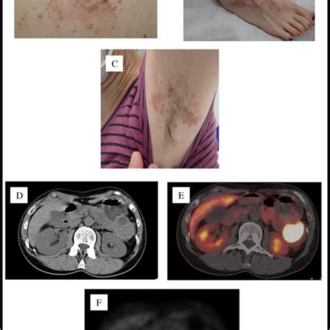 (A) Necrolytic migratory erythema with typical scaling and erythema.... | Download Scientific ...