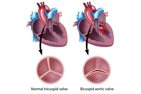 Bicuspid Aortic Valve | Conditions & Treatments | UR Medicine