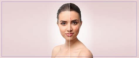 Acne Scar Resurfacing Near Me in Santa Cruz, CA