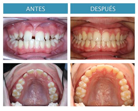 FRENECTOMIA LABIAL SUPERIOR PDF