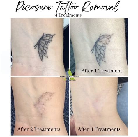 Picosure Tattoo Removal - Aesthetics of Essex