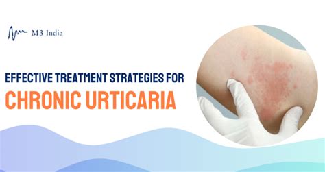 Chronic Urticaria and Treatment Protocols