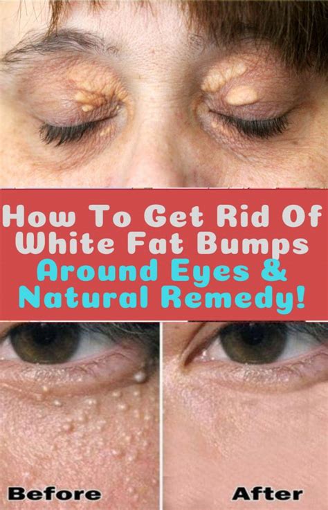 Pin by Nonzuzo Petse on natural remedies (With images) | Skin bumps, Bumps under eyes, White ...