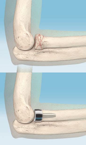 Radial Head Fracture Repair (Elbow Fracture) – Houston Hand Surgeon - Korsh Jafarnia, MD