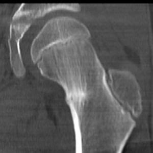 Acute Femoral Fracture