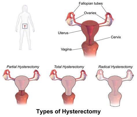 Uterus Removal - Hysterectomy Surgery Cost - Mumbai