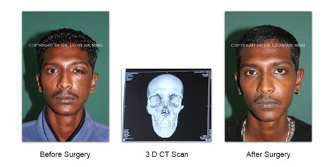 Craniofacial Trauma Reconstruction – MSPRS