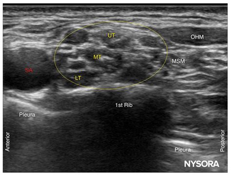 Conseils pour un bloc supraclaviculaire du plexus brachial - NYSORA