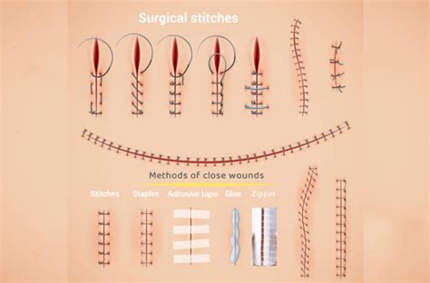 Adhesive tape, stitches, staples, zipper, glue: How to choose? - PerfectSeal