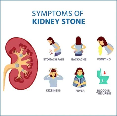 Treatment For Kidney Stones at Medicover - Causes & Symptoms