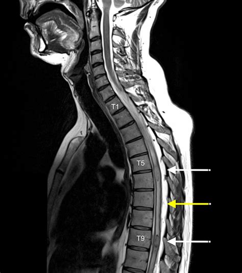 Combined intramedullary and intradural extramedullary spinal metastases ...