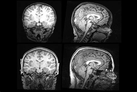 Big brain may mark subtype of autism | Spectrum | Autism Research News