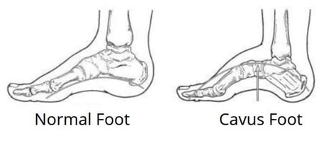 Sports Medicine and the Cavus Foot - Paragon Orthotic Laboratory