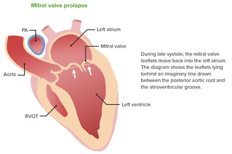 Barlow Disease Mitral Valve - Captions Trending Update