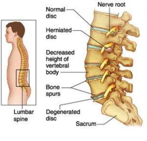 Lumbar Spondylosis And Physiotherapy Treatment, Exercise