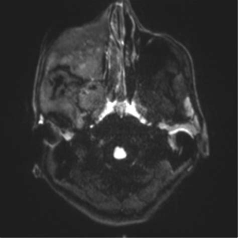 McCune-Albright syndrome | Image | Radiopaedia.org