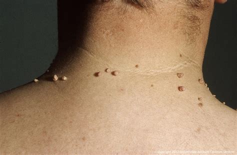 skin tags, skin growths, cosmetic dermatologist