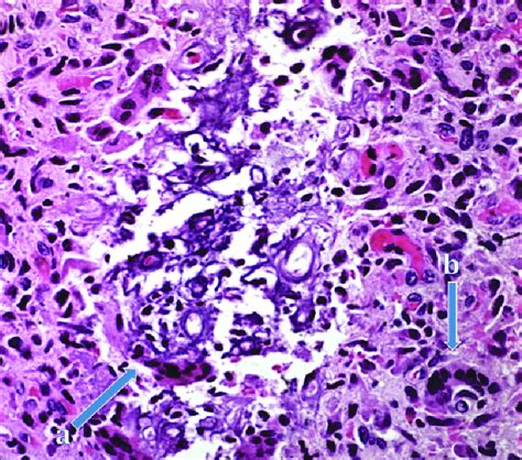 High-power micrograph showing dystrophic calcification (arrow a) and an... | Download Scientific ...