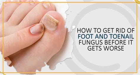 rubbing alcohol for toenail fungus - Toenail Fungus Treatment | Toenail Fungus Treatment