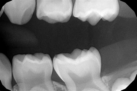 Dental X-Rays: The Whole Tooth – Pediatric Dental Blog