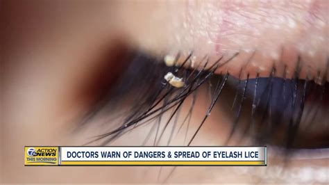 Doctors warn of lice found in eyelash extensions