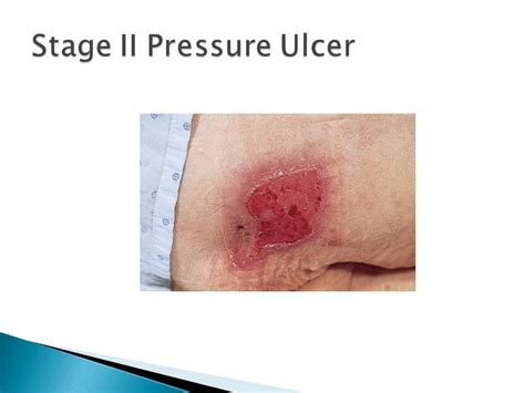 Wound Care For Stage Ii Pressure Ulcer at Michael Huffman blog