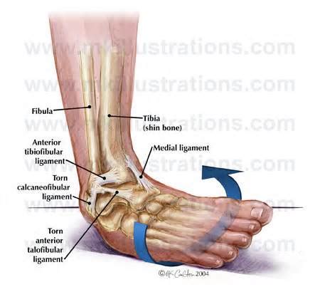 TWISTED ANKLE TREATMENT 1 - Muscle Pull | Muscle Pull