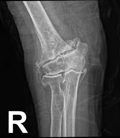 Fracture non-union | Radiology Reference Article | Radiopaedia.org