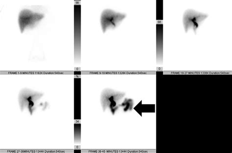 Imaging of Cholecystitis | AJR