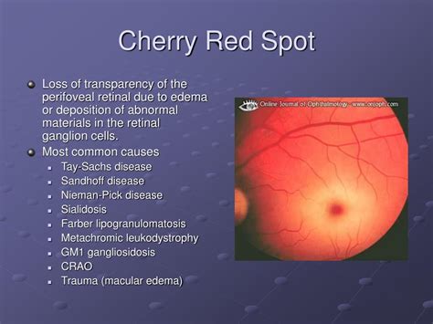 PPT - Vitreous and Retina Pediatric Ophthalmology PowerPoint ...