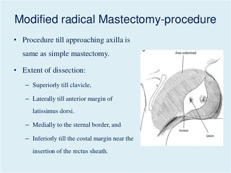 Mastectomy