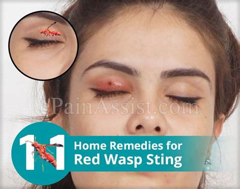 Red Paper Wasp Sting Treatment - Iwish Iwas