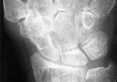 Triscaphe Degenerative Arthritis | Musculoskeletal Key