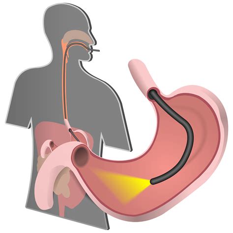 Upper GI Endoscopy – Adirondack Gastrointestinal & Colorectal Surgery