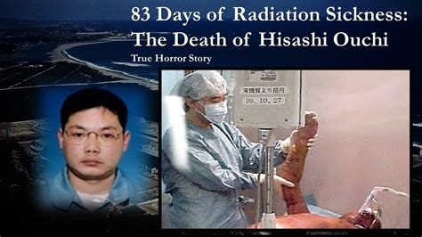 Hisashi Ouchi Radiation Exposure | Images and Photos finder