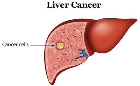 Liver Cancer - Causes, Symptoms, Diagnosis, Prognosis and Treatment