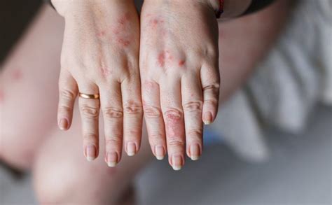 Psoriasis Vs Eczema: Let's Understand The Difference