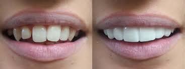 Veneers: Pros and Cons - Highstreet Dental Centre